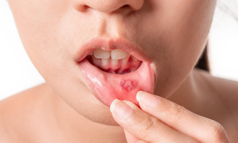لماذا تظهر قرح الفم؟ طبيب أسنان يوضح العادات الخاطئة وطرق العلاج